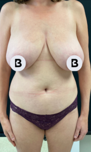 Breast Augmentation Before and After Pictures Buffalo, NY