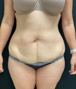 Abdominoplasty (Tummy Tuck) Before and After Pictures Buffalo, NY