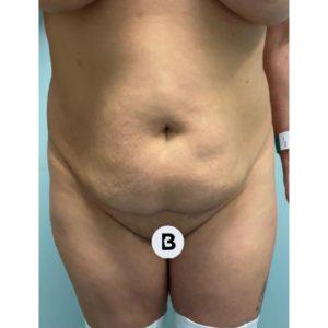 Abdominoplasty (Tummy Tuck) Before and After Pictures Buffalo, NY