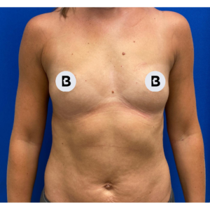 Breast Augmentation Before and After Pictures Buffalo, NY