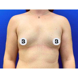 Breast Augmentation Before and After Pictures Buffalo, NY