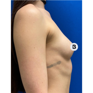 Breast Augmentation Before and After Pictures Buffalo, NY