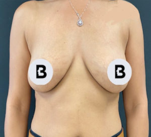 Breast Augmentation Before and After Pictures Buffalo, NY
