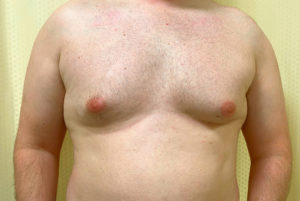 Gynecomastia (Male Chest Surgery) Before and After Pictures Buffalo, NY