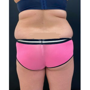 Brazilian Butt Lift Before and After Pictures Buffalo, NY