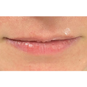 Lip Fillers Before and After Pictures Buffalo, NY