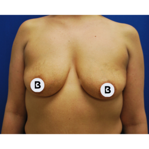 Breast Augmentation Before and After Pictures Buffalo, NY