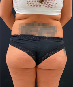 Brazilian Butt Lift Before and After Pictures in Buffalo, NY