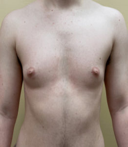 Female to Male Top Surgery Before and After Pictures Buffalo, NY