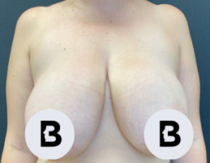 Breast Reduction Before and After Pictures Buffalo, NY