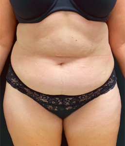 Abdominoplasty (Tummy Tuck) Before and After Pictures Buffalo, NY