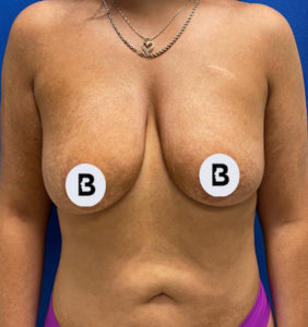 Breast Augmentation Before and After Pictures Buffalo, NY