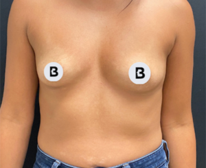 Breast Augmentation Before and After Pictures Buffalo, NY
