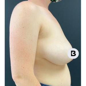 Breast Reduction Before and After Pictures Buffalo, NY