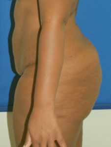 Brazilian Butt Lift Before and After Pictures Buffalo, NY