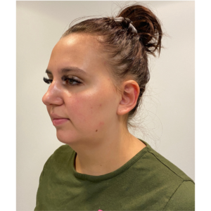 Chin Liposuction Before and After Pictures Buffalo, NY
