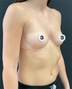 Breast Augmentation Before and After Pictures Buffalo, NY