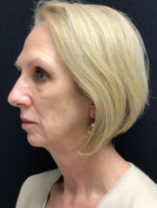 Facelift Before and After Pictures in Buffalo, NY