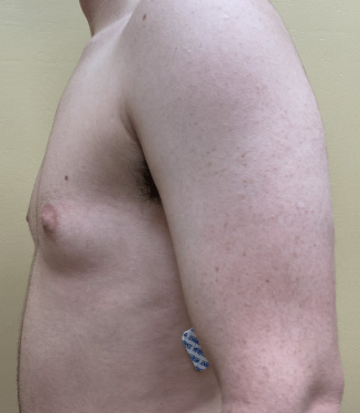 Female to Male Top Surgery Before and After Pictures Buffalo, NY