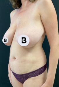 Liposuction Before and After Pictures in Buffalo, NY