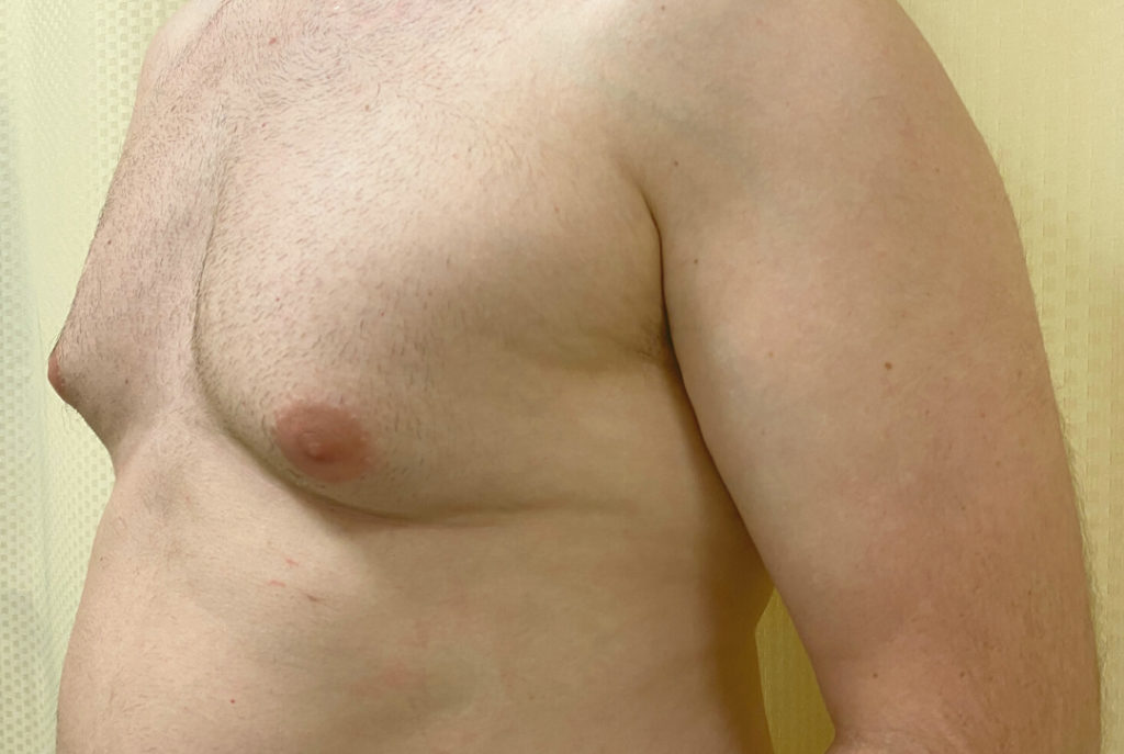Gynecomastia (Male Chest Surgery) Before and After Pictures Buffalo, NY