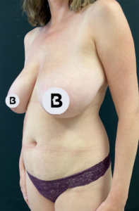 Breast Augmentation Before and After Pictures Buffalo, NY