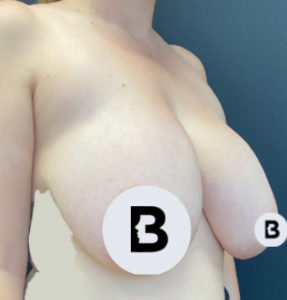 Breast Reduction Before and After Pictures Buffalo, NY