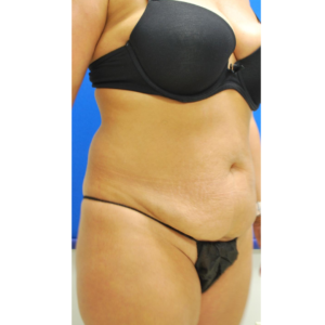 Abdominoplasty (Tummy Tuck) Before and After Pictures Buffalo, NY