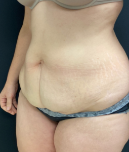 Abdominoplasty (Tummy Tuck) Before and After Pictures Buffalo, NY