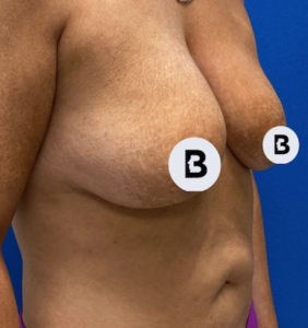 Breast Augmentation Before and After Pictures Buffalo, NY