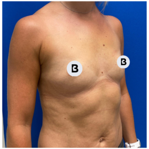 Breast Augmentation Before and After Pictures Buffalo, NY