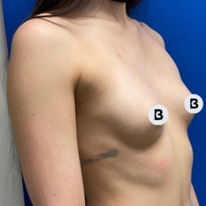 Breast Augmentation Before and After Pictures Buffalo, NY