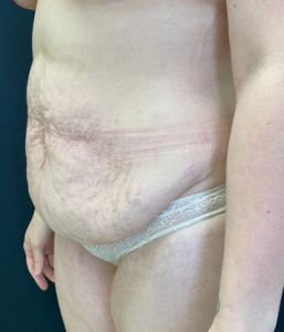 Abdominoplasty (Tummy Tuck) Before and After Pictures Buffalo, NY