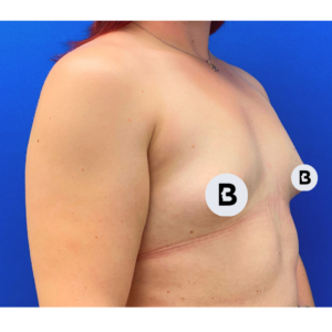 Breast Augmentation Before and After Pictures Buffalo, NY
