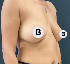 Breast Augmentation Before and After Pictures Buffalo, NY
