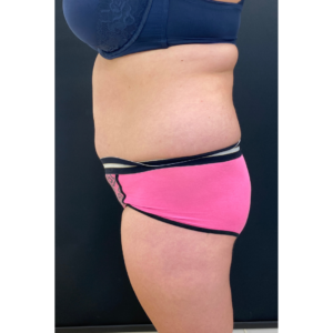 Brazilian Butt Lift Before and After Pictures Buffalo, NY