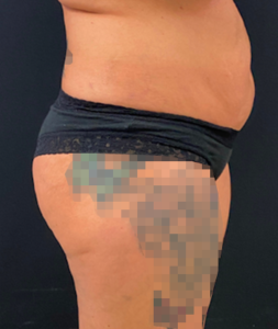 Brazilian Butt Lift Before and After Pictures in Buffalo, NY