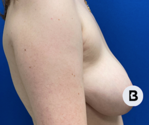 Breast Reduction Before and After Pictures in Buffalo, NY