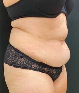 Abdominoplasty (Tummy Tuck) Before and After Pictures Buffalo, NY