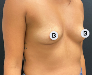 Breast Augmentation Before and After Pictures Buffalo, NY