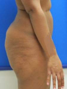 Brazilian Butt Lift Before and After Pictures Buffalo, NY