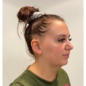 Chin Liposuction Before and After Pictures Buffalo, NY