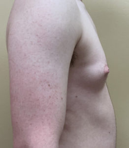 Female to Male Top Surgery Before and After Pictures Buffalo, NY