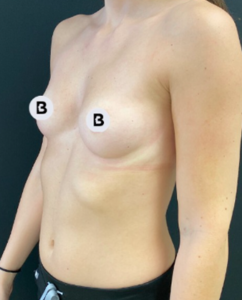 Breast Augmentation Before and After Pictures Buffalo, NY