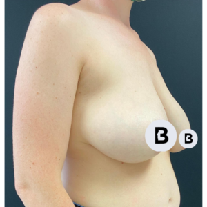 Mastopexy (Breast Lift) Before and After Pictures Buffalo, NY
