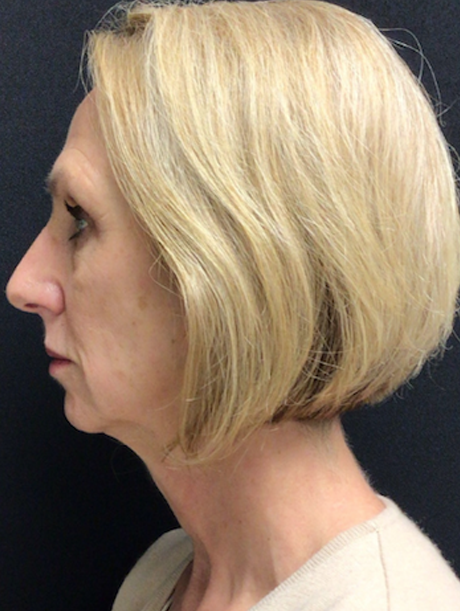 Facelift Before and After Pictures in Buffalo, NY