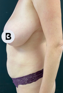Liposuction Before and After Pictures in Buffalo, NY