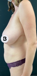 Mastopexy (Breast Lift) Before and After Pictures in Buffalo, NY