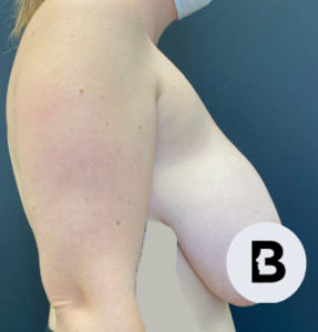 Breast Reduction Before and After Pictures Buffalo, NY