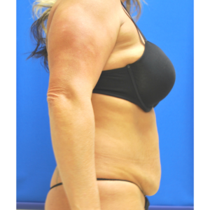 Abdominoplasty (Tummy Tuck) Before and After Pictures Buffalo, NY